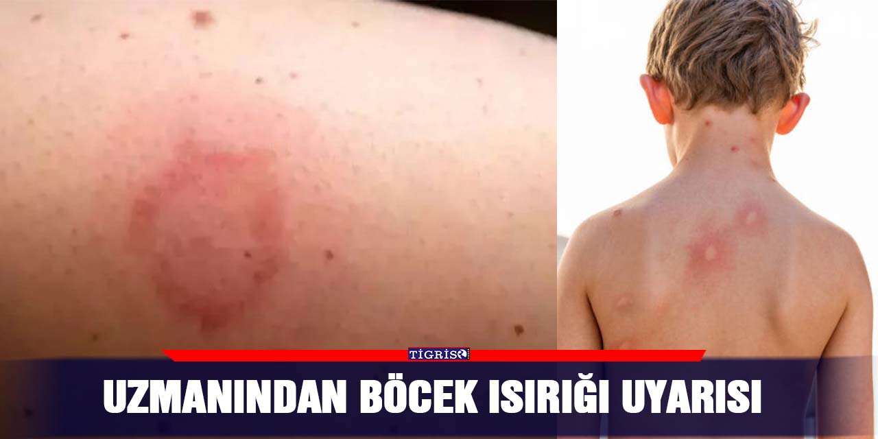 Uzmanından böcek ısırığı uyarısı