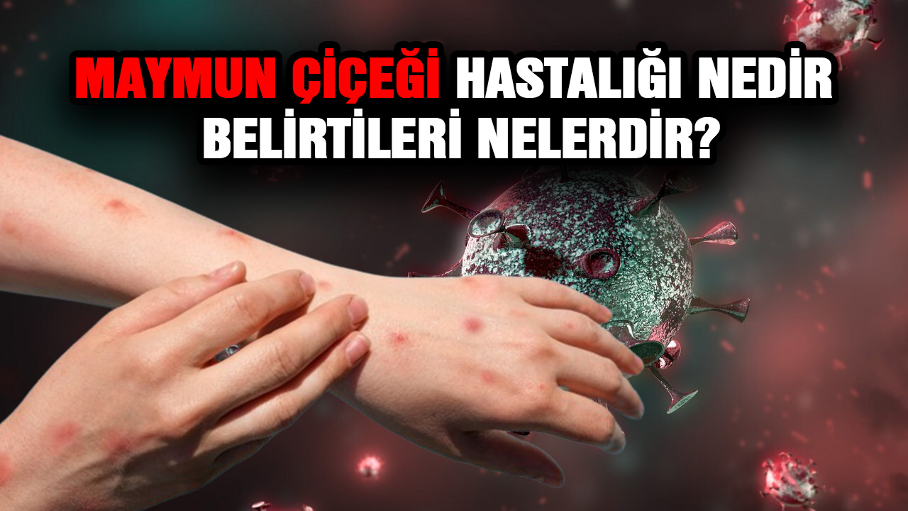 Maymun Çiçeği Hastalığı Nedir ve Belirtileri Nelerdir?