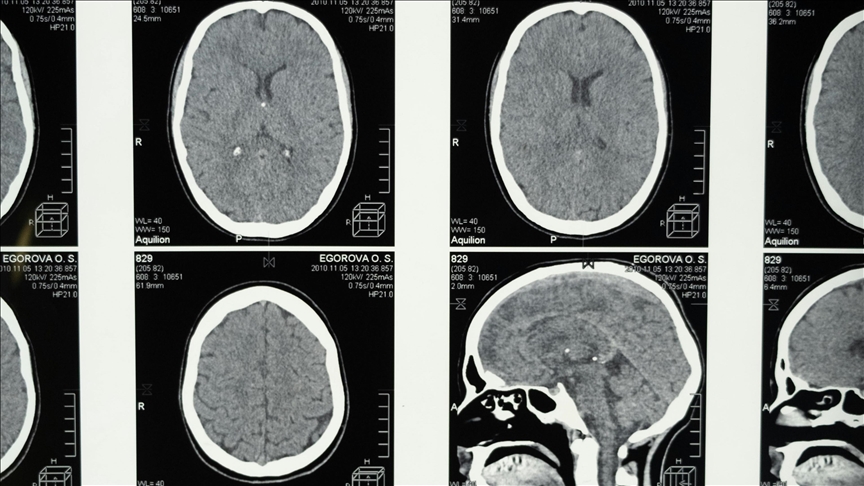 Araştırma: Uykunun REM evresine geçişte zorlanmak Alzheimer belirtisi olabilir