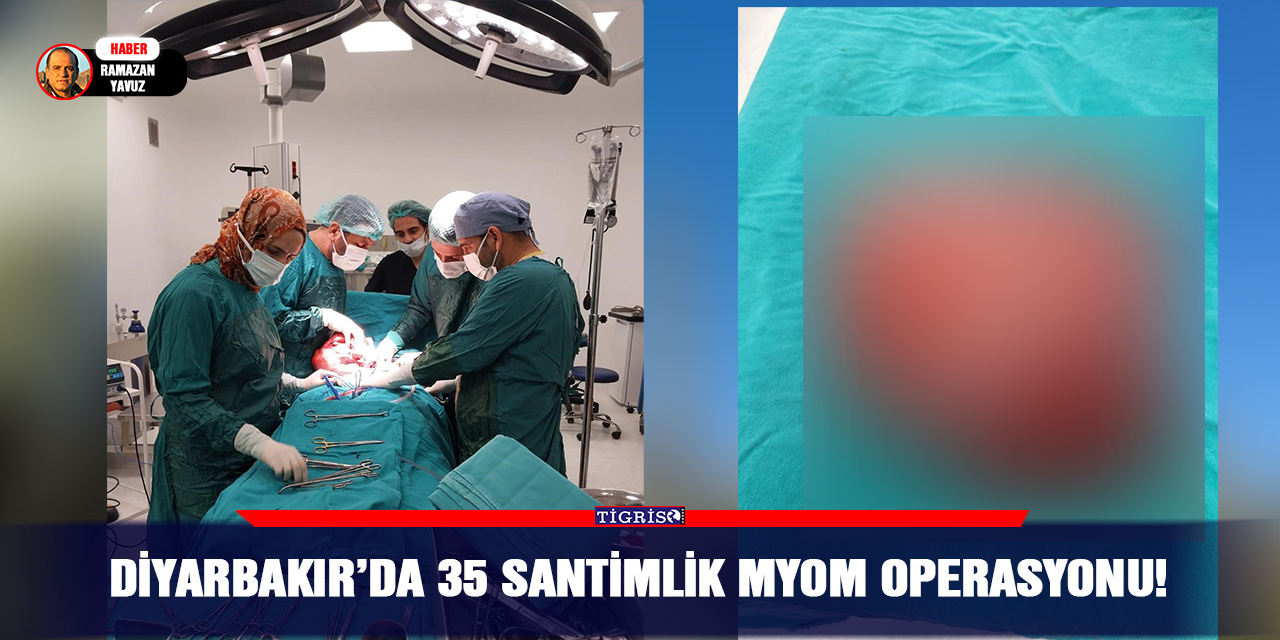 Diyarbakır’da 35 santimlik Myom operasyonu!