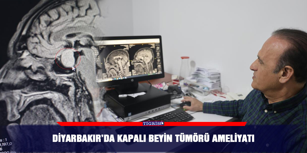 Diyarbakır’da kapalı beyin tümörü ameliyatı