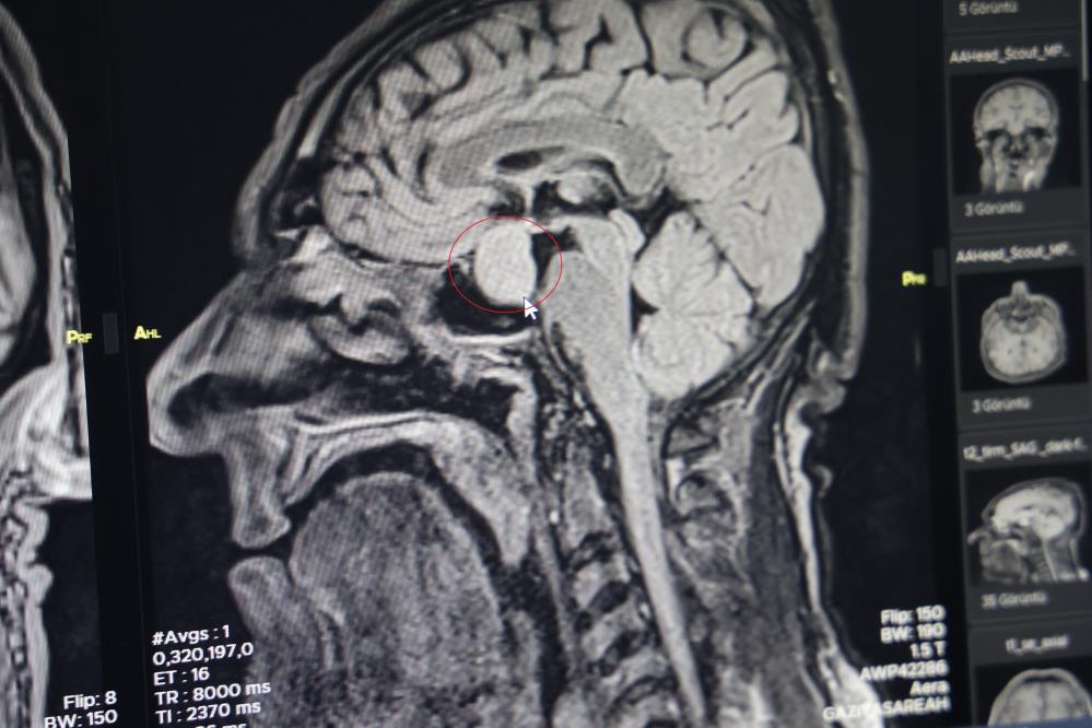 diyarbakir-gazi-yasargil-egitim-ve-arastirma-hastanesinde-ilk-kez-kapali-yontemle-beyindeki-tumor-alindi.jpg